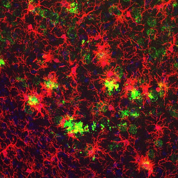 Alzheimer_Plaques_Microglia