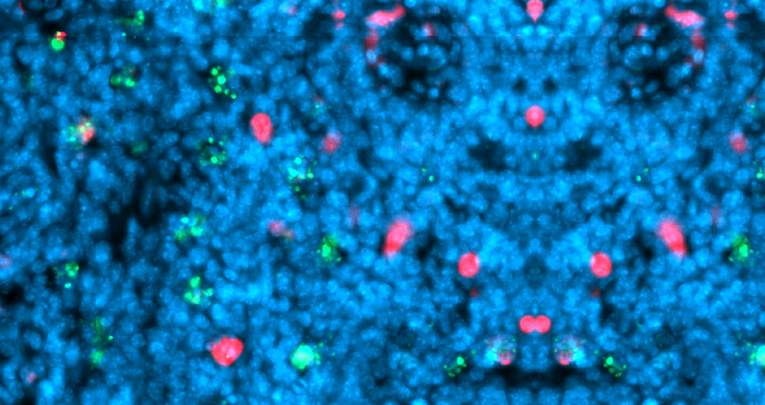 Il farmaco Lestaurtinib come terapia per il medulloblastoma 