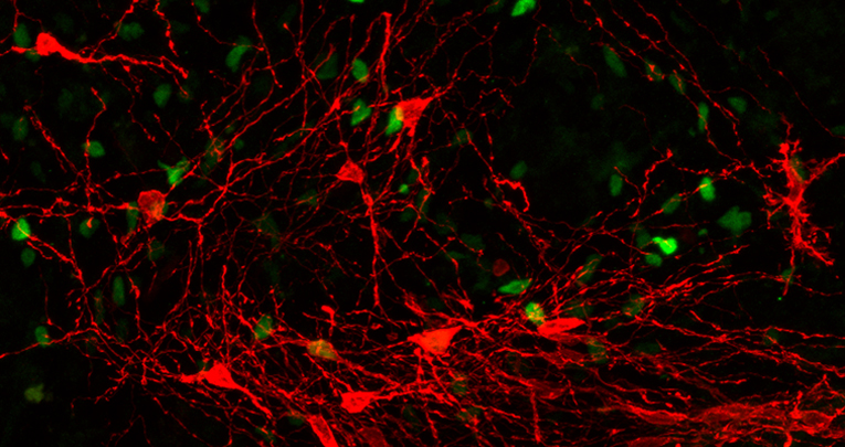 Stem Cell-Derived Human Striatal Progenitors Innervate Striatal Targets and Alleviate Sensorimotor Deficit in a Rat Model of Huntington Disease