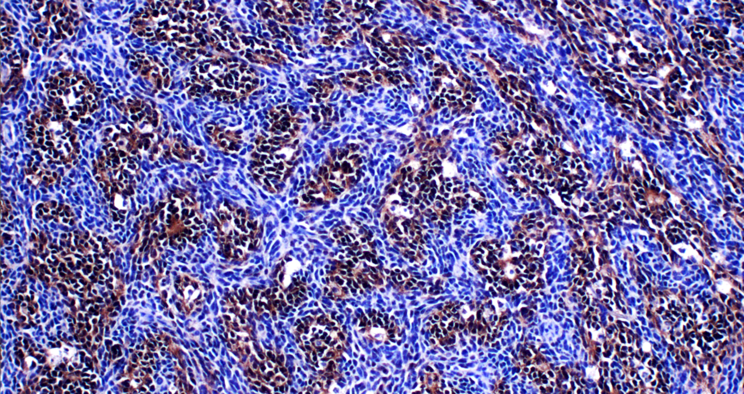 Medulloblastoma: bloccata la progressione del tumore che colpisce il cervelletto dei bambini.