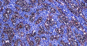 Inactivation of citron kinase inhibits medulloblastoma progression by inducing apoptosis and cell senescence.