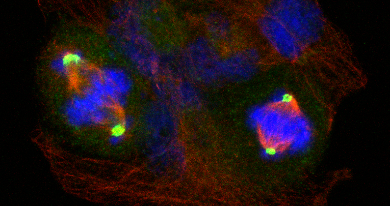 Medulloblastoma: la proteina CENPE nuovo bersaglio terapeutico?