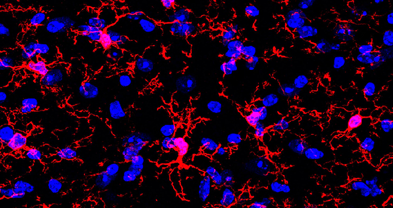 Polveri sottili nell'aria: un fattore di rischio per le patologie del sistema nervoso centrale?