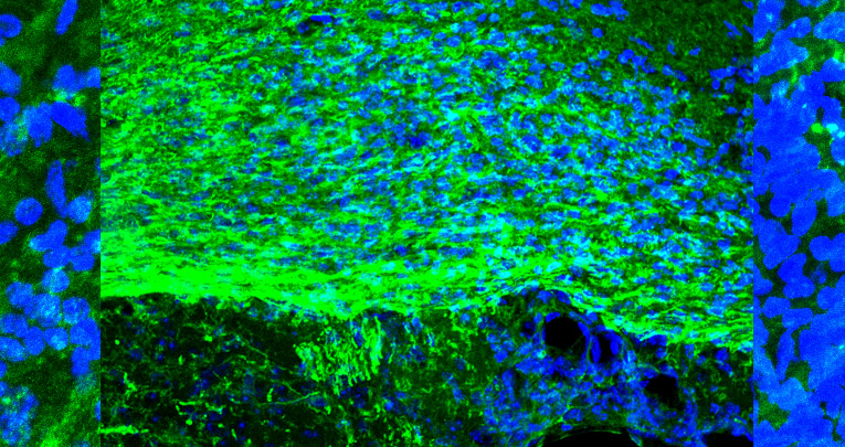 Detrimental and protective action of microglial extracellular vesicleson myelin lesions: astrocyte involvement in remyelination failure. 