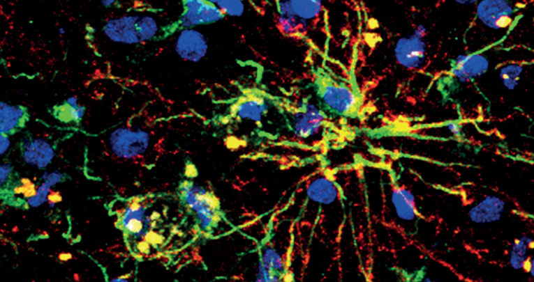 Overexpression of the ubiquitin-editing enzyme A20 in the brain lesions of Multiple Sclerosis patients