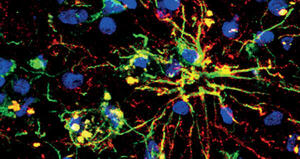 Overexpression of the ubiquitin-editing enzyme A20 in the brain lesions of Multiple Sclerosis patients