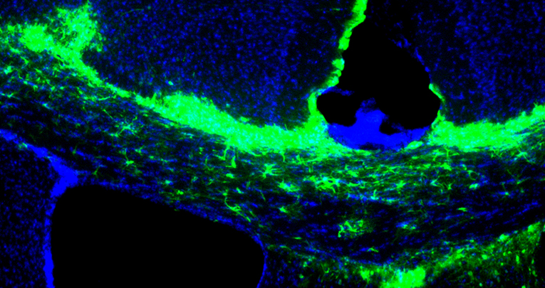 Sclerosi Multipla: un nuovo bersaglio terapeutico per promuovere il riparo della mielina 